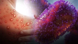 Maymun Çiçeği bir ülkede daha görüldü! Yeni tehdit yayılmaya devam ediyor