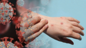 Sağlık Bakanlığı’ndan Mpox (Maymun Çiçeği) virüsü için 2024 rehberi