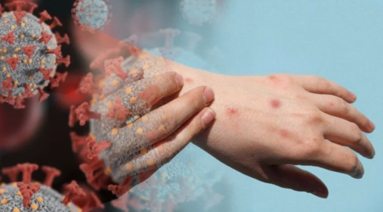 Sağlık Bakanlığı’ndan Mpox (Maymun Çiçeği) virüsü için 2024 rehberi