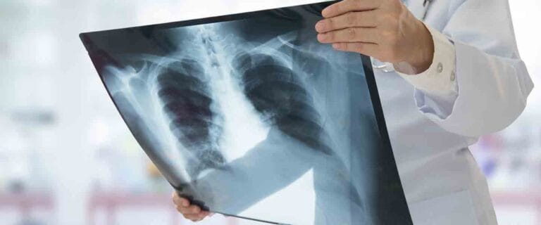 Zatürre Belirtileri Nelerdir? – Kapsamlı Bir Rehber