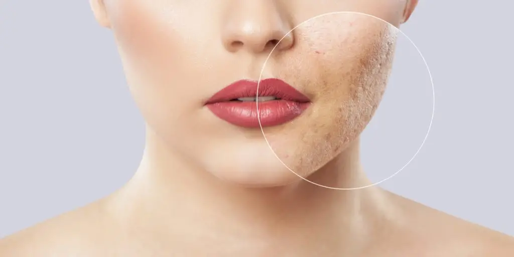 Sivilce izleri nasıl geçer? Dermatologlar açıkladı! – Birlik Haber Ajansı
