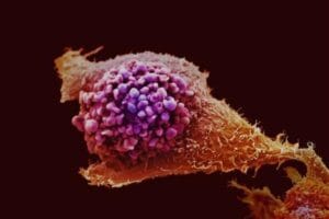 Prostat kanseri taramasında devrim: Yeni test alternatifi! – Birlik Haber Ajansı