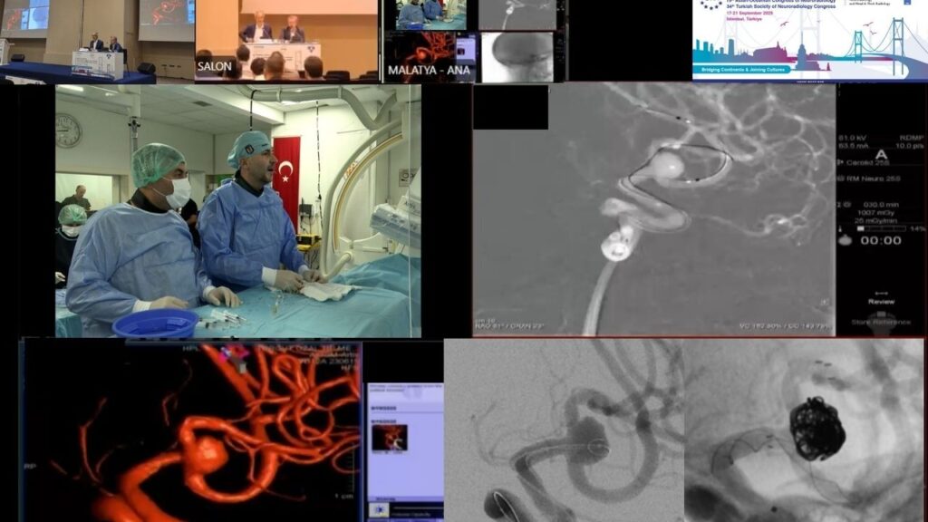 Malatya’dan dünyaya tıbbi başarı: Beyin baloncuğu tedavisi canlı yayında yapıldı – Birlik Haber Ajansı